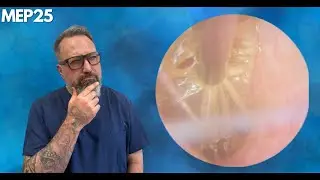 Peeling Away Ear Canal Skin & Hard Ear Wax Removal - MEP25