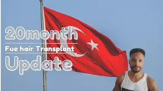 20 Month FUE Hair Transplant Update (Turkey)