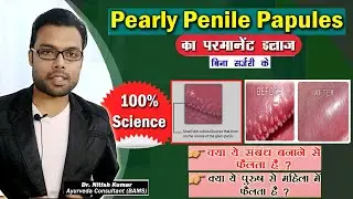 Pearly Penile Papules का इलाज | How to Treat Pearly Penile Papules | kumar's ayurvedic gyan