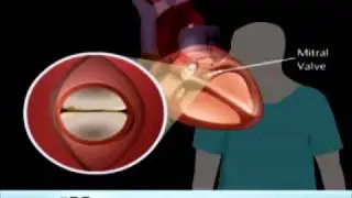 Rupture of the Heart Wall and Mitral Valve Replacement