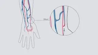 Understanding hemodialysis