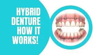Hybrid denture changing dentures forever! Is this option right for you?