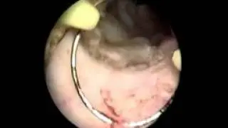 RTUP vue endoscopique