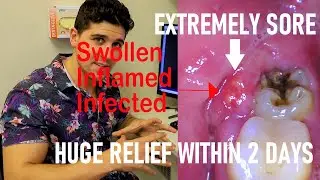 Not All Wisdom Tooth Surgery Is Bad (Partially Erupted Lower Third Molar Removal)