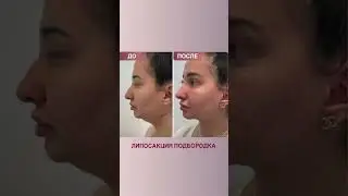 Избавились от второго подбородка. Часть 2