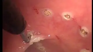Trans-Anal Endoscopic Surgery by Dr. Patricia Sylla using Autonomy L-Hook (Short Version)