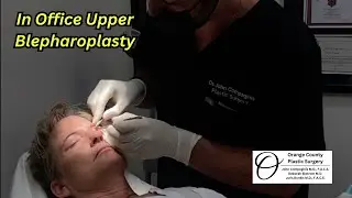 In Office Upper Blepharoplasty | Orange County Plastic Surgery #surgeryday #plasticsurgeon
