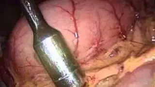 Laparoscopic Sentinel Lymph Node Biopsy (SNB) for Early Gastric Cancer