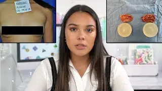 My Breast Deformity & Why I Removed My Breast Implants | Natalies Outlet