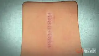 Removing Herniated Disk (Surgery Animation)