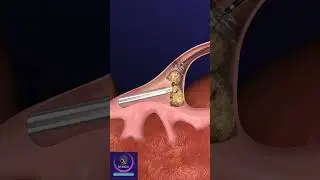 Ureteroscopy Procedure for Removal of Kidney Stones 