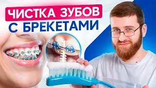 Как ухаживать за зубами с брекетами! 7 важных правил