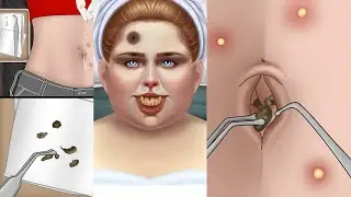 ASMR Extreme Tonsil Stone Treatment | Is Your Belly Button Clean? ASMR Remove Navel Stone Animation