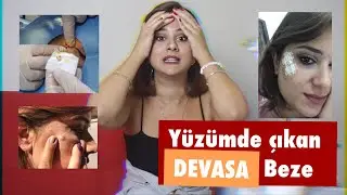 Bu benden mi çıktı? | YÜZÜMDE ÇIKAN YAĞ BEZESİNİ ALDIRDIM