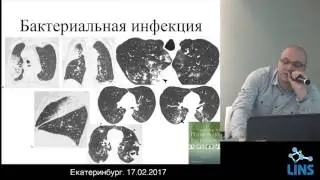 Коротков П.Б. КТ-паттерны наиболее часто встречающихся поражений легких при ВИЧ-инфекции.