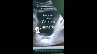 CÁLCULO VESICAL | Ultrassonografia