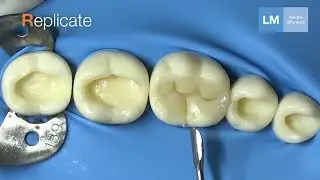 LM-Arte™ Replica Posterior - making occlusal modeling fast, simple and predictable