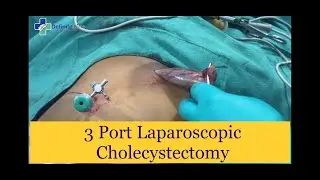 3 Port Laparoscopic cholecystectomy | पित्त की पथरी कैसे निकाली जाती है l