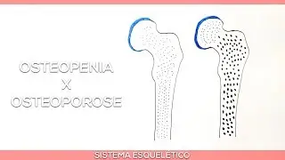 Difference Between Osteopenia and Osteoporosis