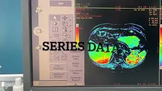 GE MRI Subtraction