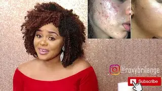 How To Get Rid Of Acne  Fast With Just  2 Products