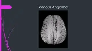 Brain Venous Malformations