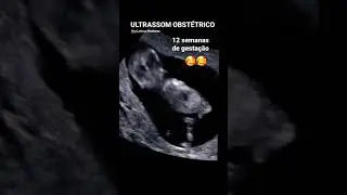 12 SEMANAS DE GESTAÇÃO (mexendo muito 😆) | Ultrassom obstétrico