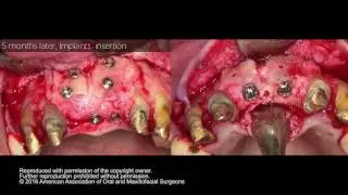 Combined Surgical Therapies for Vertical and Horizontal Ridge Augmentation