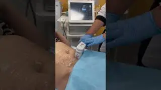SMAS лифтинг тела