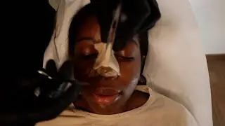 Ethnic rhinoplasty in Turkey BEFORE and AFTER