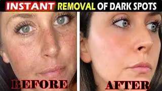 Instantly Remove Dark Spots, Brown Spots & Hyperpigmentation | Get Clear, Smooth Skin Naturally