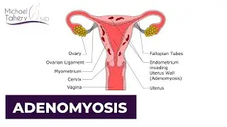 Adenomyosis | Los Angeles | Dr. Michael Tahery