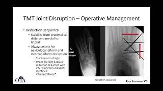 Midfoot fractures and dislocations - 2 of 2