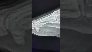 Medial hallux sesamoid fracture - Not to miss on foot Radiograph