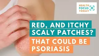 Red, and Itchy Scaly Patches? That Could be Psoriasis