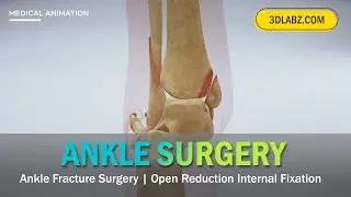 Ankle Fracture Surgery 3D Animation | Open Reduction Internal Fixation  | Syndesmosis Stabilization