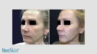 Aerolase NeoSkin Laser for Skin Rejuvenation