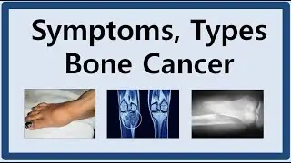Bone Cancer Symptoms and Types