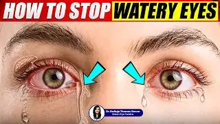 How to Stop Watery Eyes | Watery Eyes Treatment