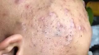 Tokyo Acne Treatment Blackhead Extractions Popping | HaiAu #53