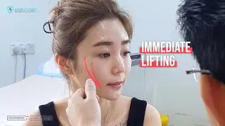 Dermal Fillers- Taller Nose, Sharper Chin and Jawline