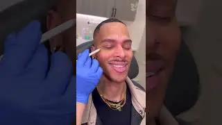 Botox for Men