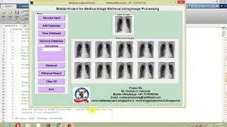 Medical Image Retrieval Using Matlab Project with Source Code IEEE Based Project