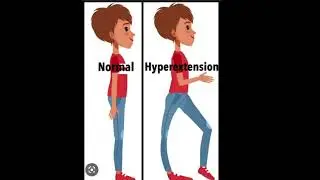 ✨Genu recurvatum👉 Knee HyperExtension...