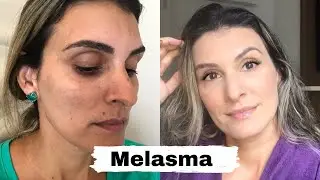 Melasma : Acabe com as manchas na pele ! / Nati Nahas