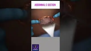 Abdominal C-Section Delivery