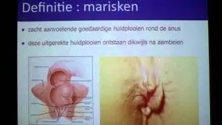 Marisken - proctologie - Dr. Tom Feryn