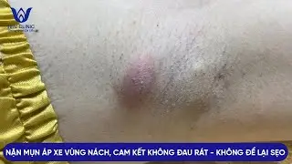 ĐIỀU TRỊ MỤN NHỌT - ÁP XE VÙNG NÁCH, CAM KẾT HIỆU QUẢ SAU 1 BUỔI VÀ KHÔNG ĐỂ LẠI SẸO TẠI HHV CLINIC.