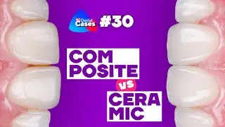 Composite VS Ceramic  | BG Dental Cases #30
