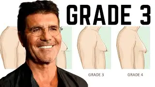 Gynecomastia Grade 3 Treatment: Achieving Optimal Results